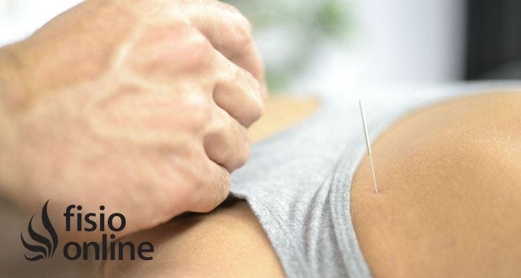Puncion seca para contracturas musculares